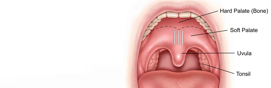 pillar implants a simple safe way to cure snoring